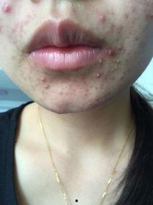 痤疮可以吃角瓜,痤疮患者的天然食疗选择