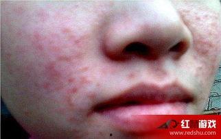 痤疮可以吃角瓜,痤疮患者的天然食疗选择